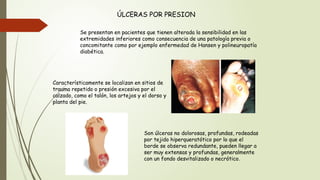 ÚLCERAS POR PRESION
Se presentan en pacientes que tienen alterada la sensibilidad en las
extremidades inferiores como consecuencia de una patología previa o
concomitante como por ejemplo enfermedad de Hansen y polineuropatía
diabética.
Característicamente se localizan en sitios de
trauma repetido o presión excesiva por el
calzado, como el talón, los artejos y el dorso y
planta del pie.
Son úlceras no dolorosas, profundas, rodeadas
por tejido hiperqueratótico por lo que el
borde se observa redundante, pueden llegar a
ser muy extensas y profundas, generalmente
con un fondo desvitalizado o necrótico.
 