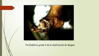 Pie Diabético grado 4 de la clasificación de Wagner
 