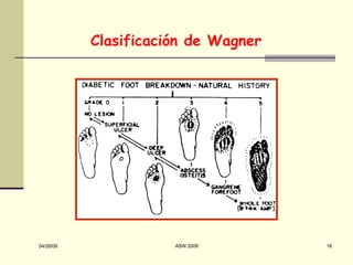 Clasificación de Wagner 