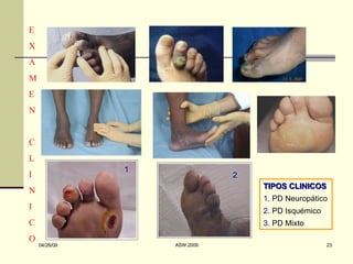 E X A M E N C L I N I C O 1 2 TIPOS CLINICOS 1 . PD Neuropático 2 . PD Isquémico 3 . PD Mixto 