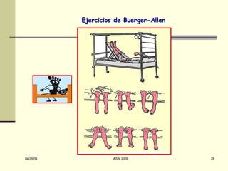 Ejercicios de Buerger-Allen 