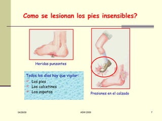 Como se lesionan los pies insensibles? Heridas punzantes Presiones en el calzado Todos los días hay que vigilar: Los pies Los calcetines Los zapatos 