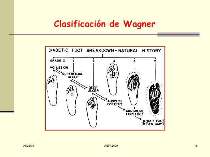 Pie Diabetico Aspectos Clinicos y Preventivos