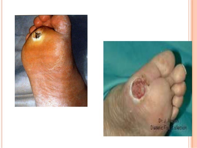 Pie diabetico cirugia Pie diabetico cirugia