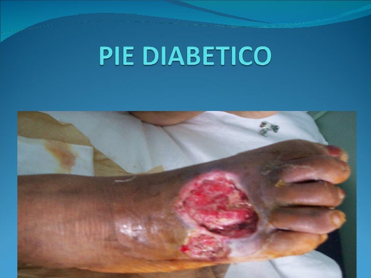 Pie diabetic ocopia Pie diabetic ocopia