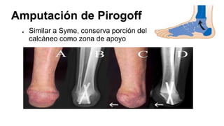 Amputación de Pirogoff
● Similar a Syme, conserva porción del
calcáneo como zona de apoyo
 