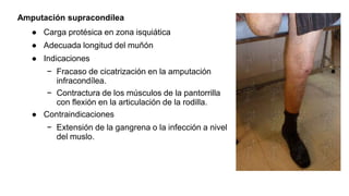 Amputación supracondílea
● Carga protésica en zona isquiática
● Adecuada longitud del muñón
● Indicaciones
− Fracaso de cicatrización en la amputación
infracondílea.
− Contractura de los músculos de la pantorrilla
con flexión en la articulación de la rodilla.
● Contraindicaciones
− Extensión de la gangrena o la infección a nivel
del muslo.
 