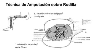 Técnica de Amputación sobre Rodilla
1.- incisión: corte de colgajos/
torniquete
2.- disección muscular/
corte fémur.
 