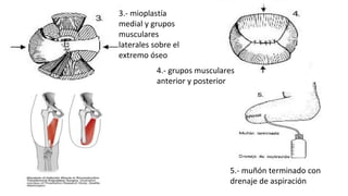 3.- mioplastía
medial y grupos
musculares
laterales sobre el
extremo óseo
4.- grupos musculares
anterior y posterior
5.- muñón terminado con
drenaje de aspiración
 