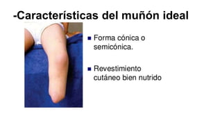 -Características del muñón ideal
 
