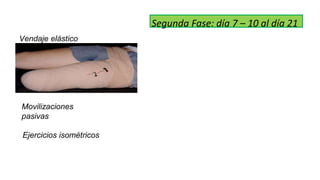 Segunda Fase: día 7 – 10 al día 21
Vendaje elástico
Movilizaciones
pasivas
Ejercicios isométricos
 