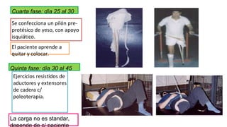 Cuarta fase: día 25 al 30
Se confecciona un pilón pre-
protésico de yeso, con apoyo
isquiático.
El paciente aprende a
quitar y colocar.
Quinta fase: día 30 al 45
Ejercicios resistidos de
aductores y extensores
de cadera c/
poleoterapia.
La carga no es standar,
 