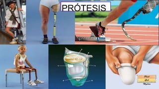 PRÓTESIS
 
