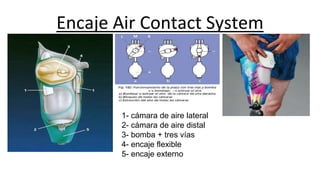 Encaje Air Contact System
1- cámara de aire lateral
2- cámara de aire distal
3- bomba + tres vías
4- encaje flexible
5- encaje externo
 