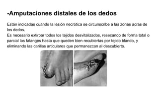 -Amputaciones distales de los dedos
Están indicadas cuando la lesión necrótica se circunscribe a las zonas acras de
los dedos.
Es necesario extirpar todos los tejidos desvitalizados, resecando de forma total o
parcial las falanges hasta que queden bien recubiertas por tejido blando, y
eliminando las carillas articulares que permanezcan al descubierto.
 