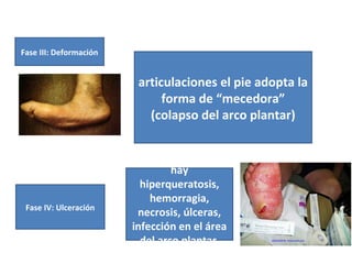 Fase III: Deformación
articulaciones el pie adopta la
forma de “mecedora”
(colapso del arco plantar)
Fase IV: Ulceración
hay
hiperqueratosis,
hemorragia,
necrosis, úlceras,
infección en el área
del arco plantar
 