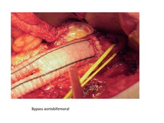 Bypass aortobifemoral
 