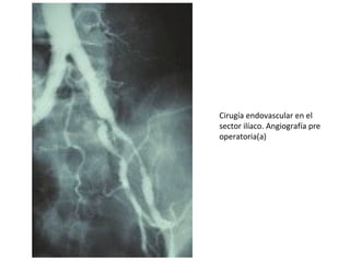 Cirugía endovascular en el
sector ilíaco. Angiografía pre
operatoria(a)
 
