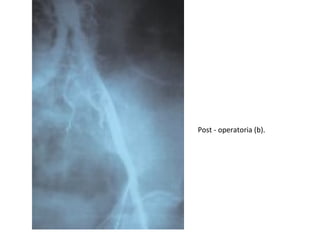 Post - operatoria (b).
 