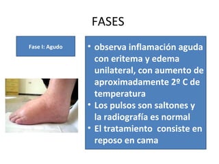 FASES
Fase I: Agudo • observa inflamación aguda
con eritema y edema
unilateral, con aumento de
aproximadamente 2º C de
temperatura
• Los pulsos son saltones y
la radiografía es normal
• El tratamiento consiste en
reposo en cama
 