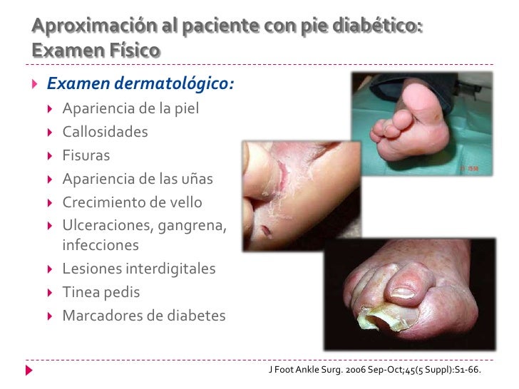 Pie diabético Pie diabético