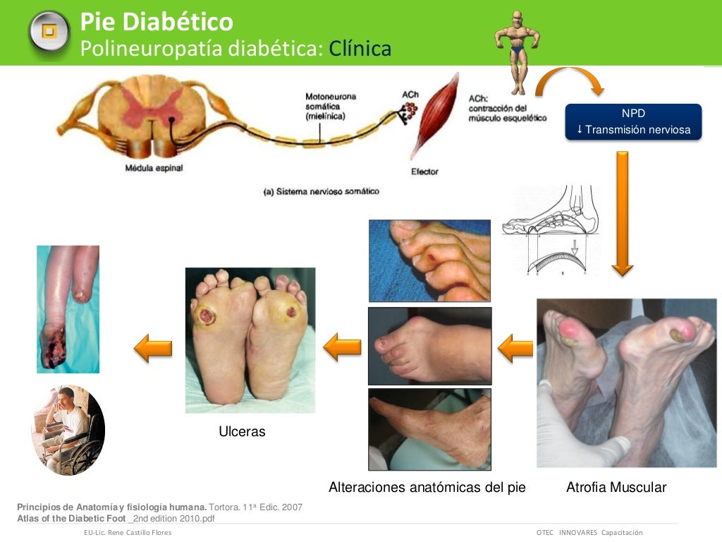 Pie diabético etiopatogenia neuropatia otec innovares
