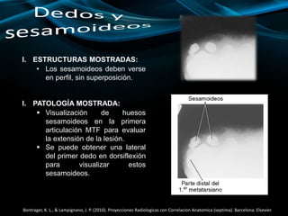 I. ESTRUCTURAS MOSTRADAS:
• Los sesamoideos deben verse
en perfil, sin superposición.
I. PATOLOGÍA MOSTRADA:
 Visualización de huesos
sesamoideos en la primera
articulación MTF para evaluar
la extensión de la lesión.
 Se puede obtener una lateral
del primer dedo en dorsiflexión
para visualizar estos
sesamoideos.
Bontrager, K. L., & Lampignano, J. P. (2010). Proyecciones Radiologicas con Correlacion Anatomica (septima). Barcelona: Elsevier.
 