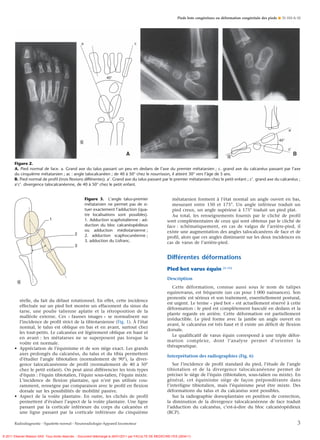 Varus Defor Pieds bots congénitaux ou déformation congénitale des pieds | PDF