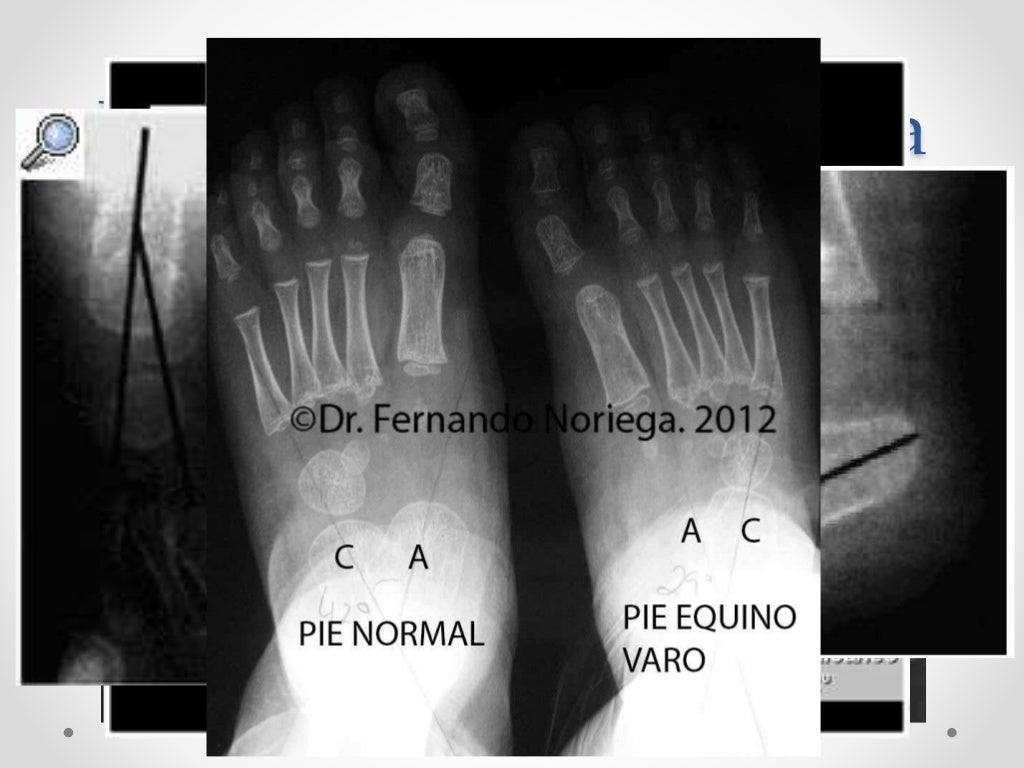 Pie equino varo