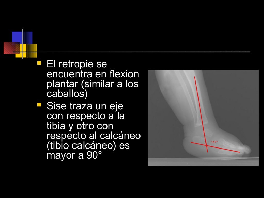 Pie equino varoadducto congénito
