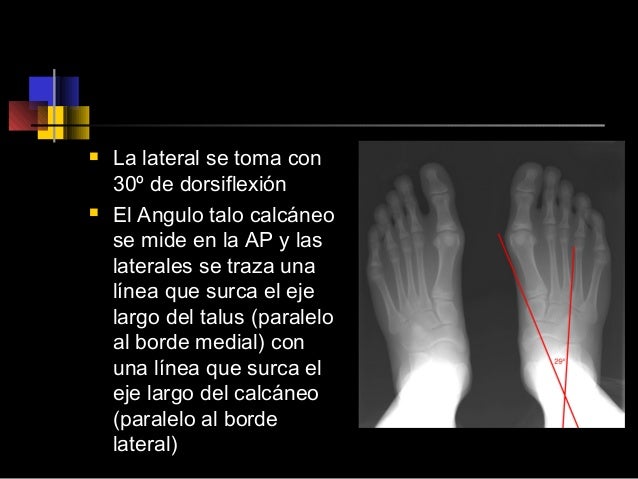Pie equino varo-adducto congénito