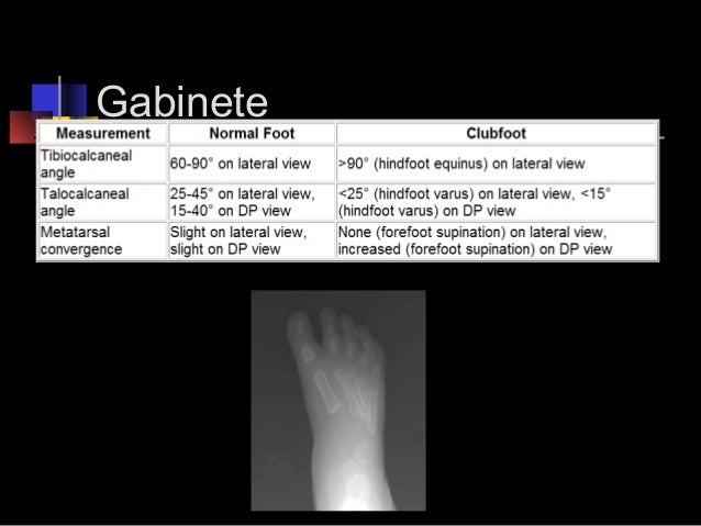 Pie equino varo-adducto congénito