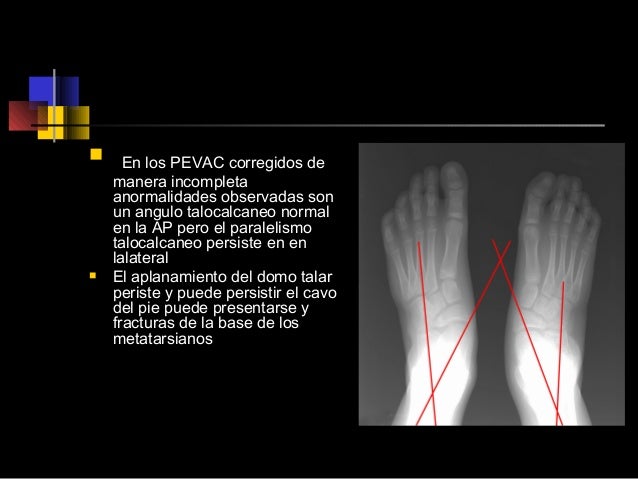 Pie equino varo-adducto congénito