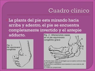 La planta del pie esta mirando hacia arriba y adentro, el pie se encuentra completamente invertido y el antepie adducto. 