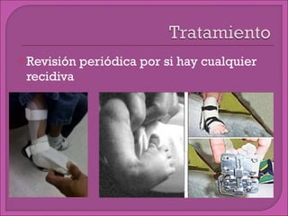 Revisión periódica por si hay cualquier recidiva 