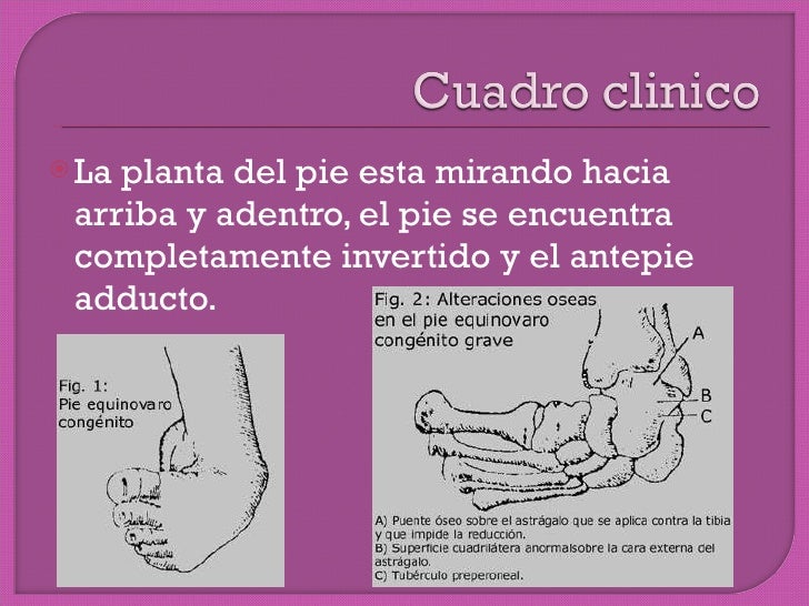 Pie equino varo bilateral