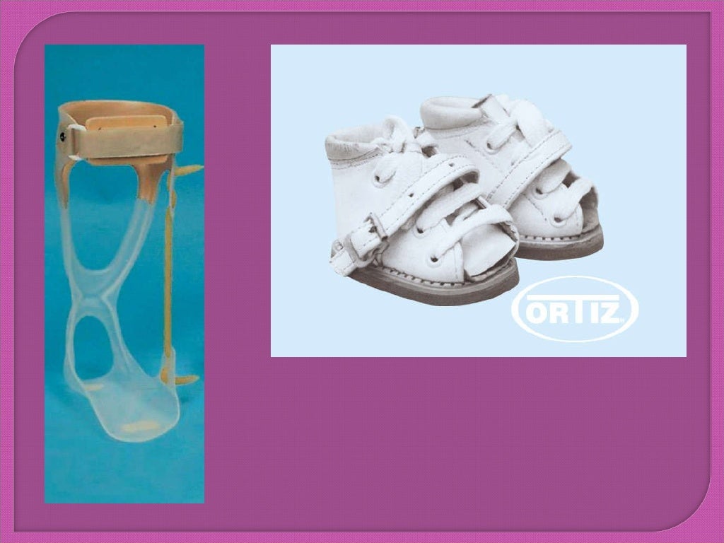 Pie equino varo bilateral