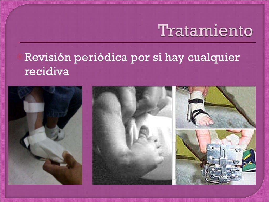 Pie equino varo bilateral