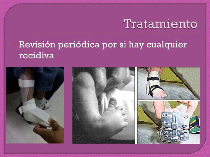 Pie equino varo bilateral