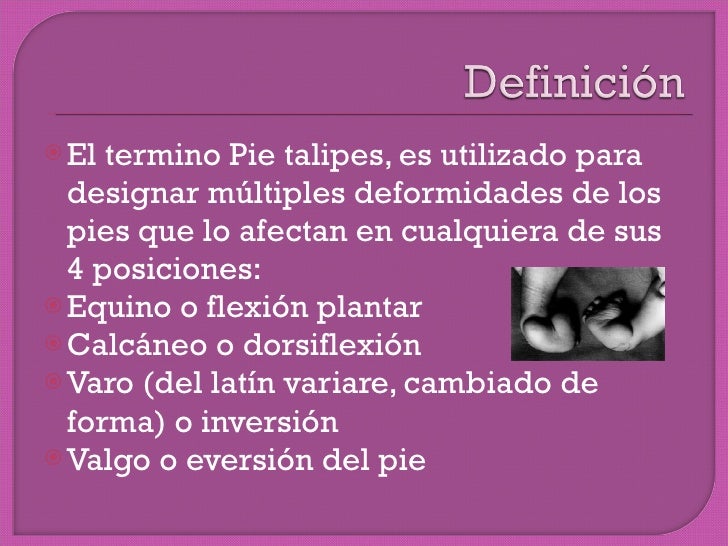 Pie equino varo bilateral