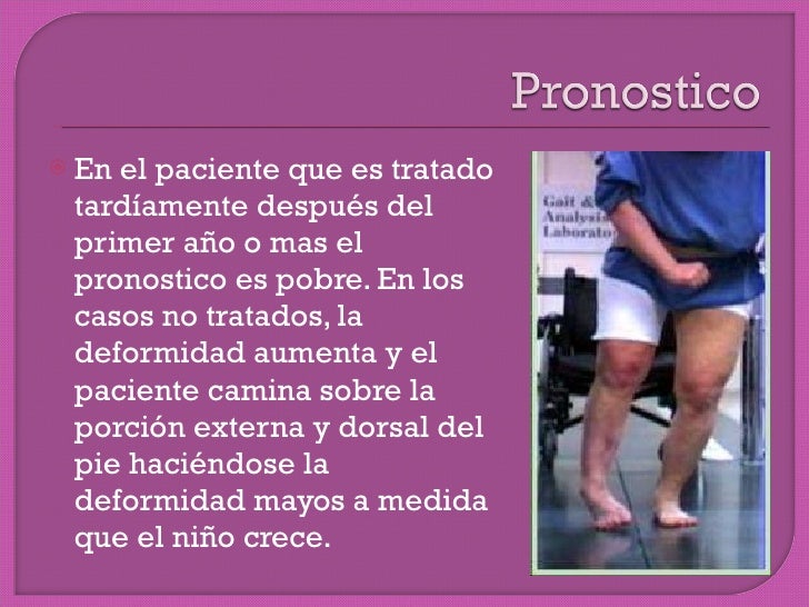 Pie equino varo bilateral