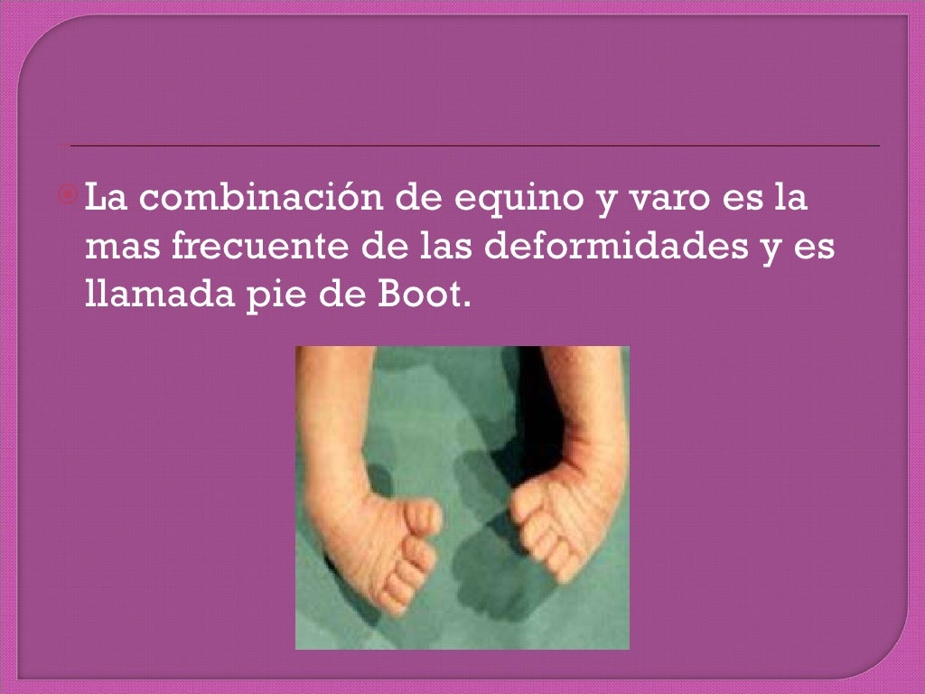 Pie equino varo bilateral