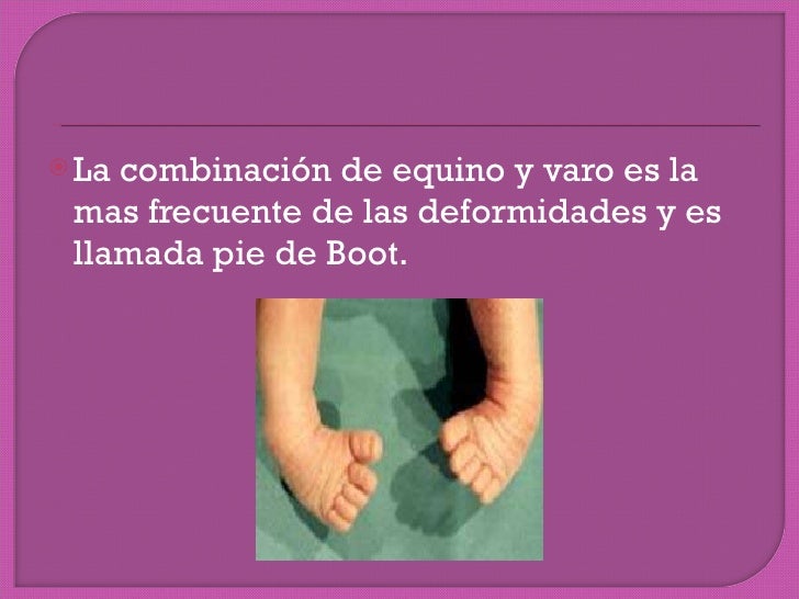 Pie equino varo bilateral