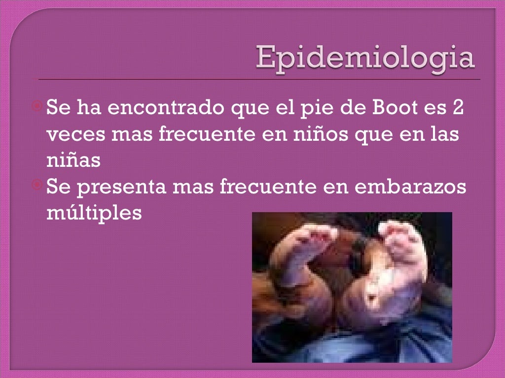 Pie equino varo bilateral