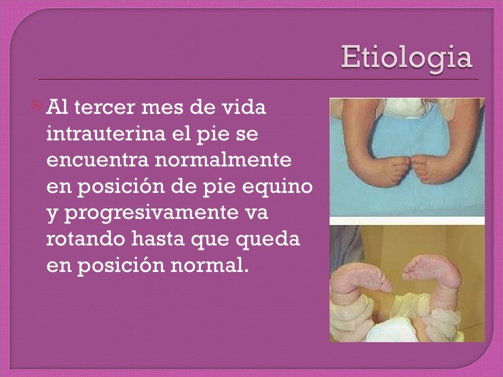 Pie equino varo bilateral