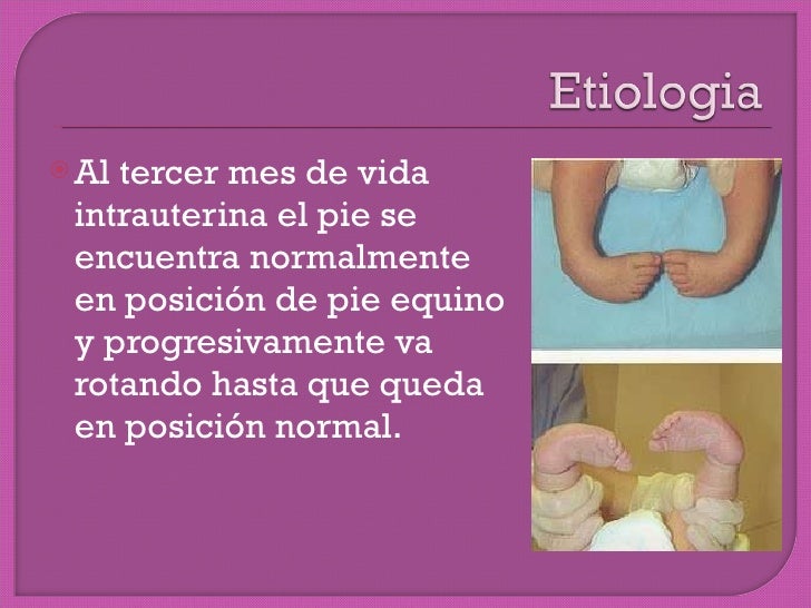 Pie equino varo bilateral