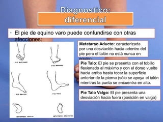 • El pie de equino varo puede confundirse con otras
afecciones:
Metatarso Aducto: caracterizada
por una desviación hacia adentro del
pie pero el talón no está nunca en
equino
Pie Talo: El pie se presenta con el tobillo
flexionado al máximo y con el dorso vuelto
hacia arriba hasta tocar la superficie
anterior de la pierna (sólo se apoya el talón
mientras la punta se encuentra en alto.
Pie Talo Valgo: El pie presenta una
desviación hacia fuera (posición en valgo)
 