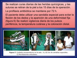 • Se realizan curas diarias de las heridas quirúrgicas, y las
suturas se retiran de la piel a los 15 días de la operación.
• La profilaxis antibiótica se mantiene por 72 h.
• El paciente debe utilizar una sandalia especial para evitar la
flexión de los dedos y la aparición de una deformidad fija
(figura 6) Se realizó vigilancia diaria de los pulsos
periféricos, la temperatura cutánea y la coloración distal.
 