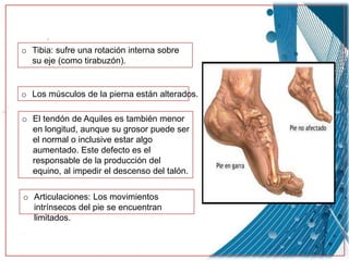 o Tibia: sufre una rotación interna sobre
su eje (como tirabuzón).
o Los músculos de la pierna están alterados.
o El tendón de Aquiles es también menor
en longitud, aunque su grosor puede ser
el normal o inclusive estar algo
aumentado. Este defecto es el
responsable de la producción del
equino, al impedir el descenso del talón.
o Articulaciones: Los movimientos
intrínsecos del pie se encuentran
limitados.
 