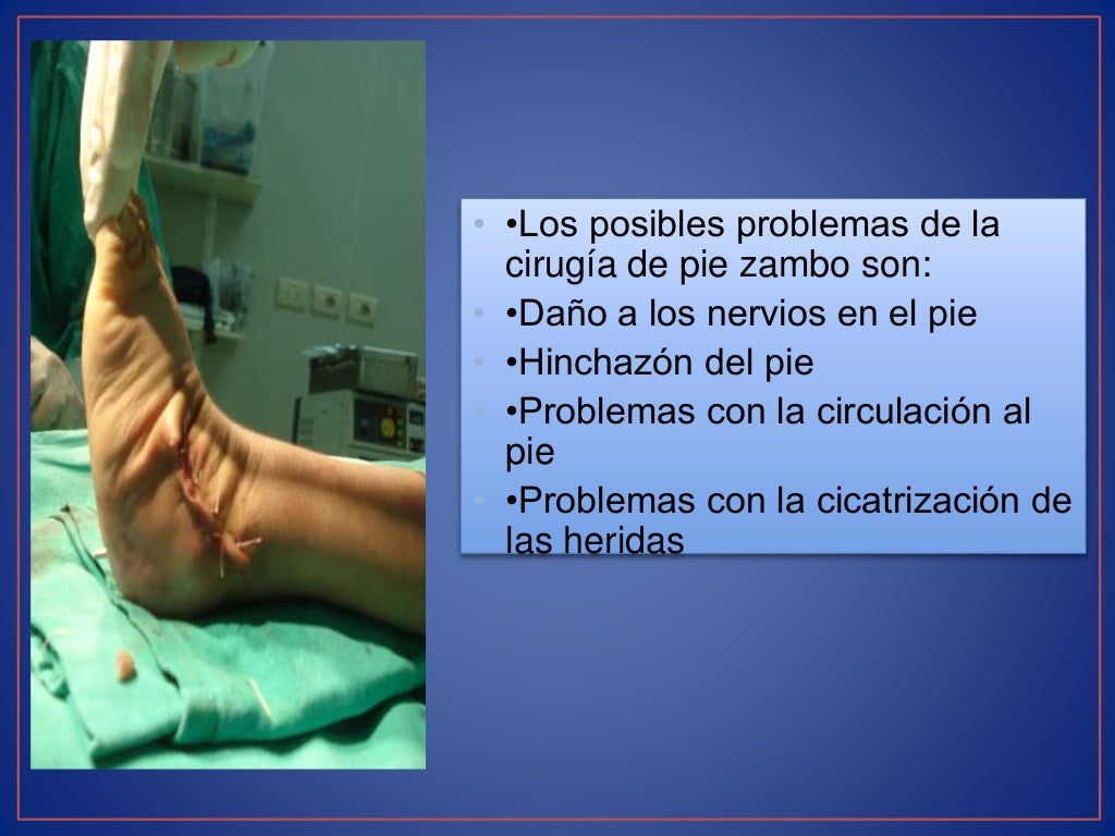 Pie equino varo charla